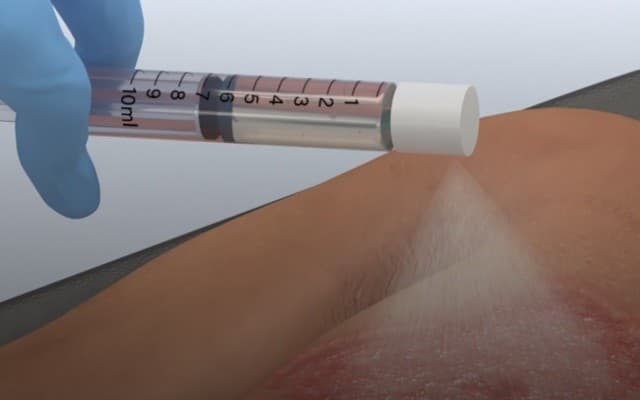 AVITA Medical prepares to launch its regenerative burn treatment in the US