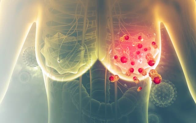 ImpediMed welcomes NCCN’s updated breast cancer guidelines to provide early lymphoedema screening