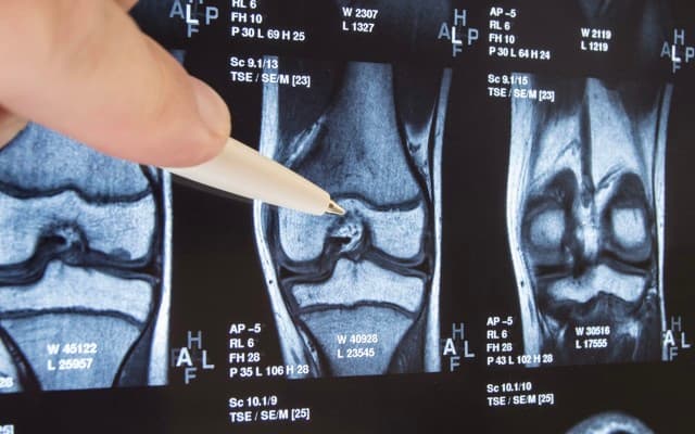 Paradigm Biopharma’s knee osteoarthritis trial meets secondary endpoints, launches capital raise
