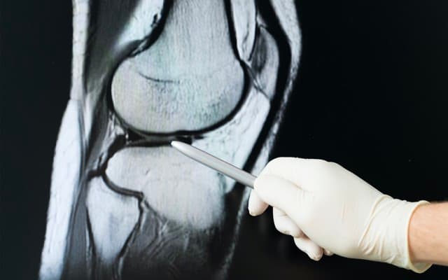 Paradigm Biopharma’s knee osteoarthritis trial shows injectable drug can slow cartilage degradation