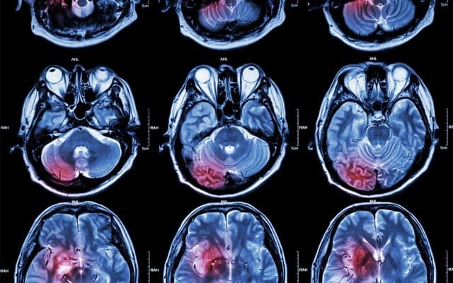 Patrys publishes upbeat pre-clinical data in the fight against brain cancer