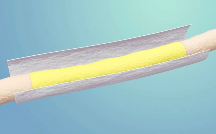 ReNerve study shows major patient outcome benefits of NervAlign nerve cuff