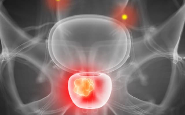 Telix Pharmaceuticals to begin phase two prostate cancer imaging study